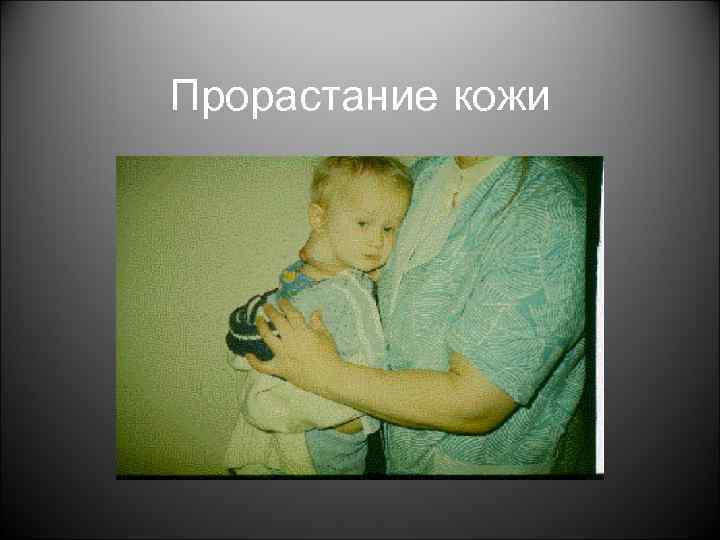 Прорастание кожи 