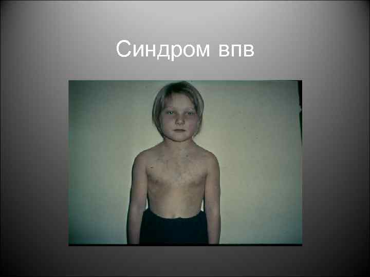 Синдром впв 