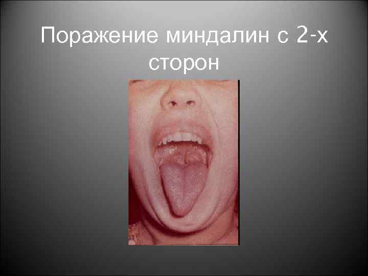 Поражение миндалин с 2 -х сторон 