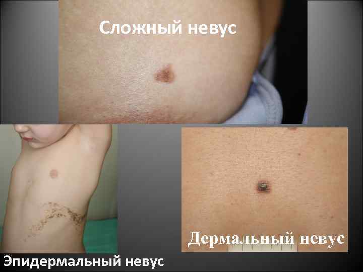 Сложный невус Дермальный невус Эпидермальный невус 
