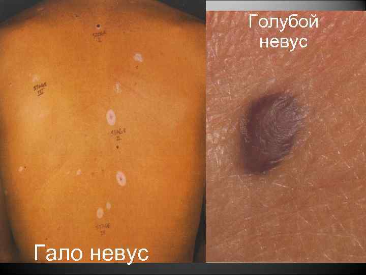Голубой невус Гало невус 