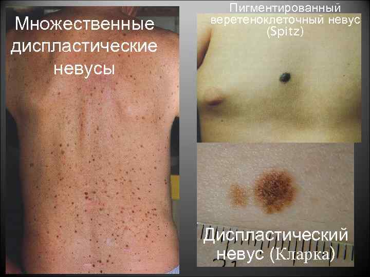 Множественные диспластические невусы Пигментированный веретеноклеточный невус (Spitz) Диспластический невус (Кларка) 