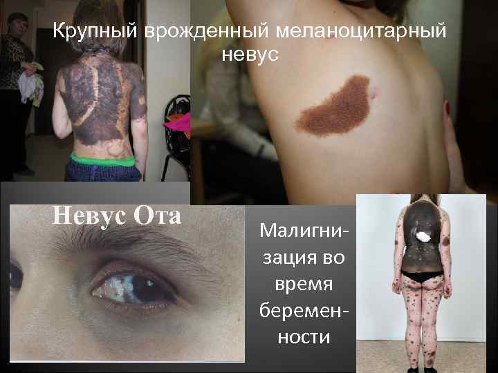 Крупный врожденный меланоцитарный невус Невус Ота Малигнизация во время беременности 