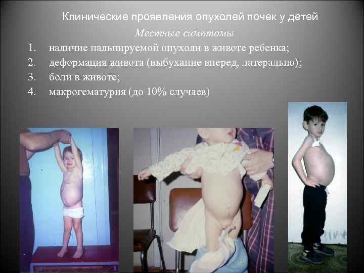 1. 2. 3. 4. Клинические проявления опухолей почек у детей Местные симптомы наличие пальпируемой