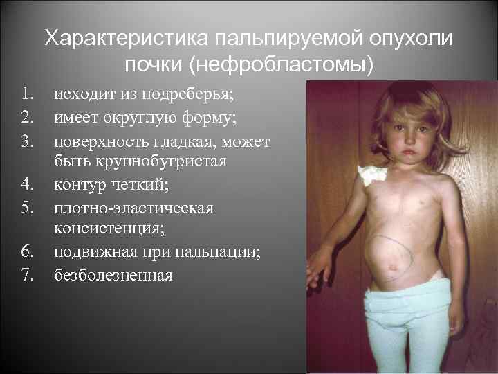 Характеристика пальпируемой опухоли почки (нефробластомы) 1. 2. 3. 4. 5. 6. 7. исходит из