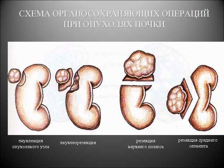 СХЕМА ОРГАНОСОХРАНЯЮЩИХ ОПЕРАЦИЙ ПРИ ОПУХОЛЯХ ПОЧКИ энуклеация опухолевого узла энуклеорезекция верхнего полюса резекция среднего
