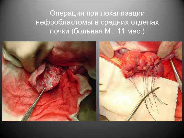 Операция при локализации нефробластомы в средних отделах почки (больная М. , 11 мес. )