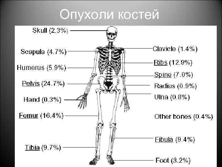 Опухоли костей 