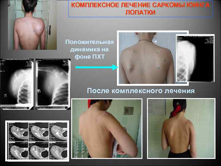 КОМПЛЕКСНОЕ ЛЕЧЕНИЕ САРКОМЫ ЮИНГА ЛОПАТКИ Положительная динамика на фоне ПХТ После комплексного лечения 