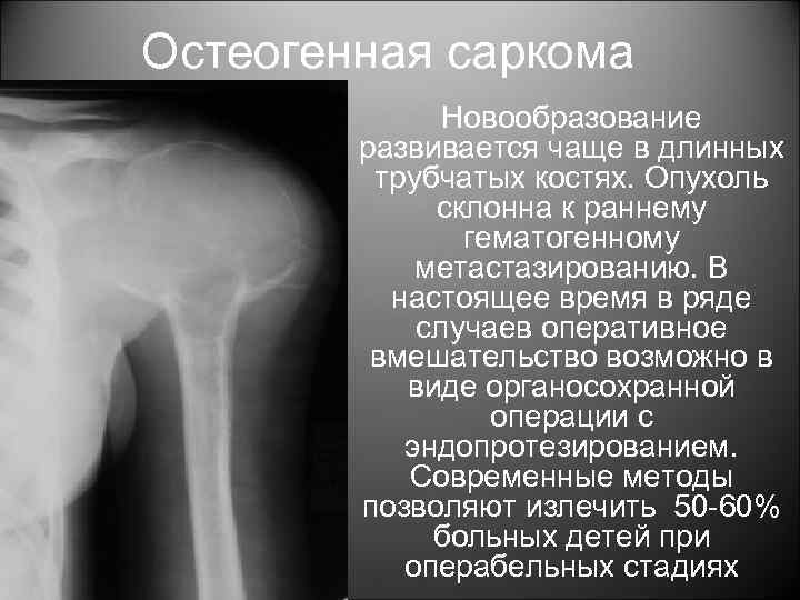 Чем отличается саркома. Остеогенная саркома кости. Саркома Юинга трубчатой кости. Остеогенная саркома рентген. Остеогенная саркома локализация.