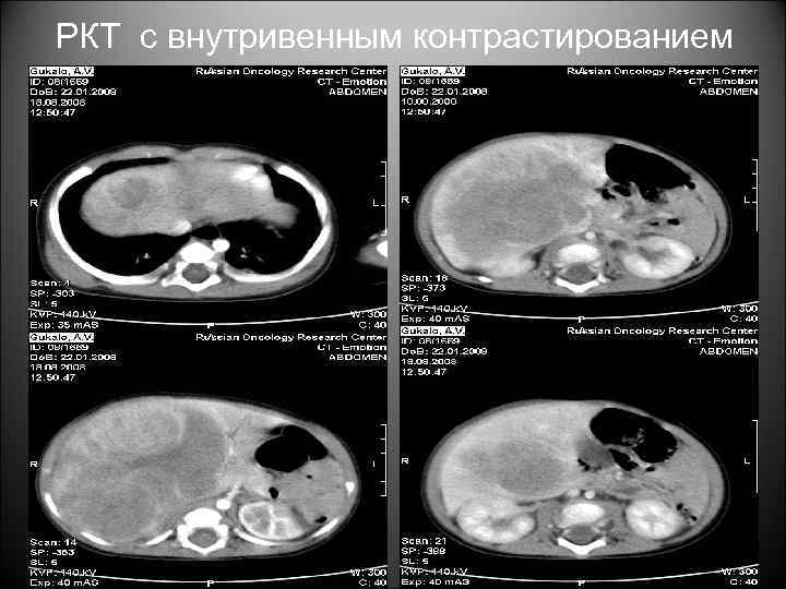 РКТ с внутривенным контрастированием 