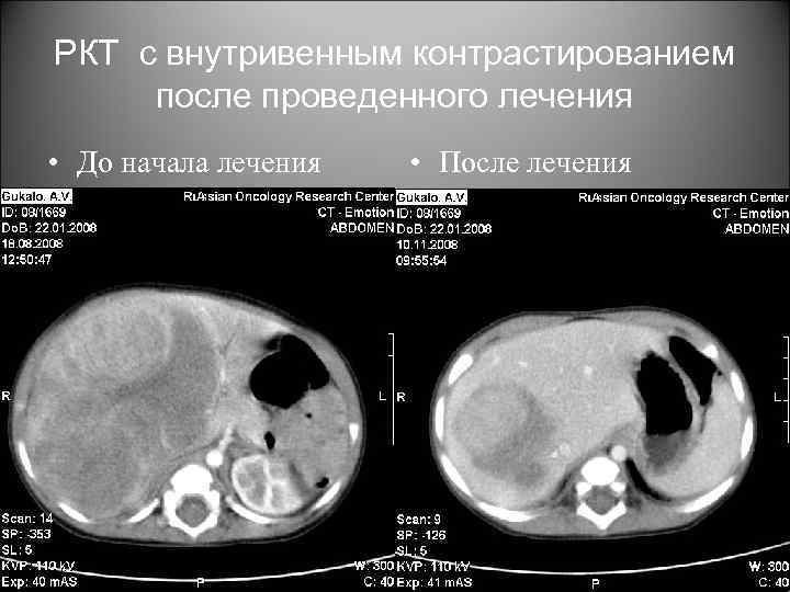 РКТ с внутривенным контрастированием после проведенного лечения • До начала лечения • После лечения