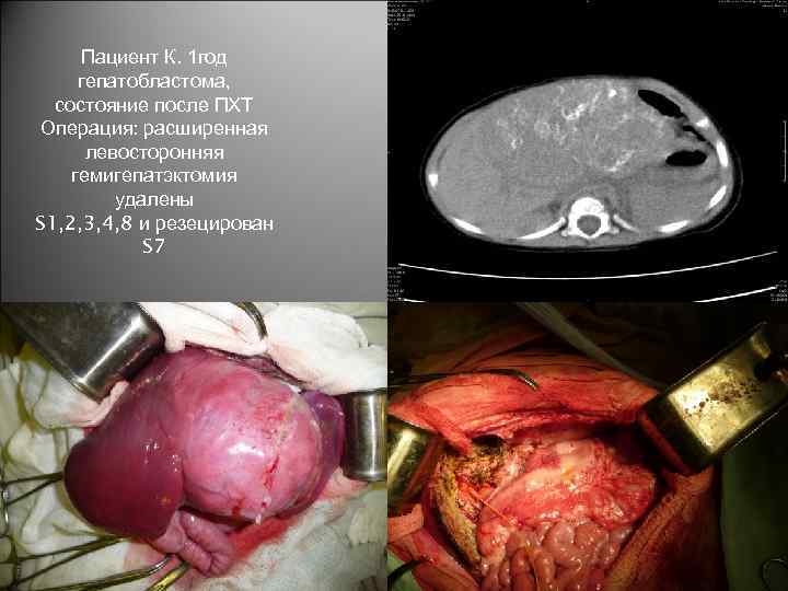 Пациент К. 1 год гепатобластома, состояние после ПХТ Операция: расширенная левосторонняя гемигепатэктомия удалены S