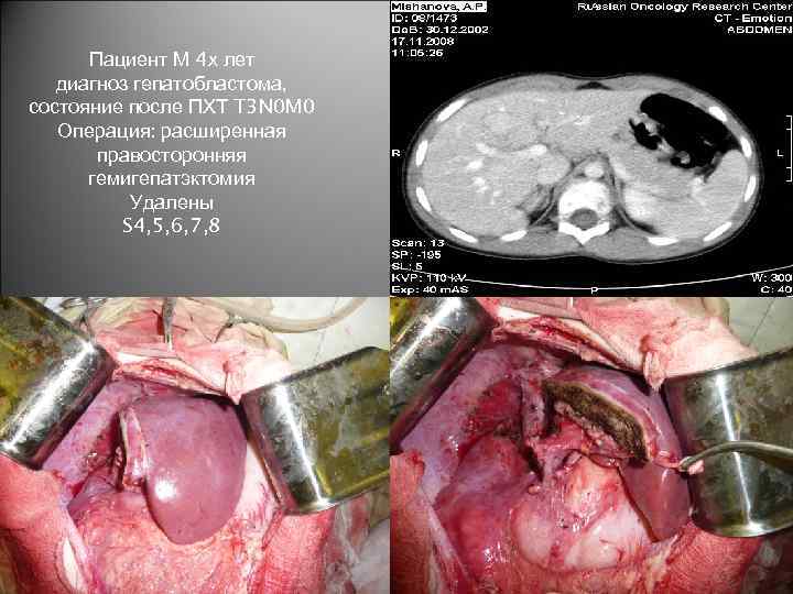 Пациент М 4 х лет диагноз гепатобластома, состояние после ПХТ T 3 N 0