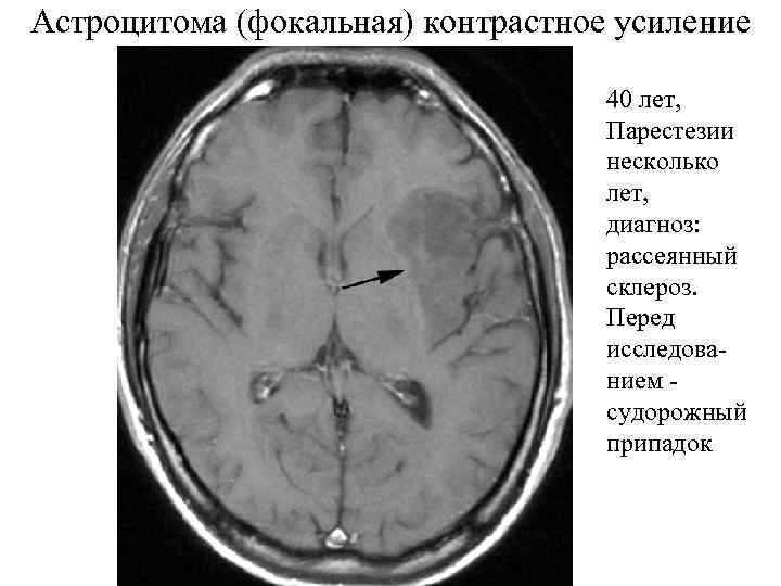 Астроцитома (фокальная) контрастное усиление 40 лет, Парестезии несколько лет, диагноз: рассеянный склероз. Перед исследованием