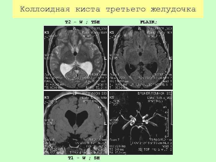 Коллоидная киста третьего желудочка T 2 - W ; TSE TI = 1300 T