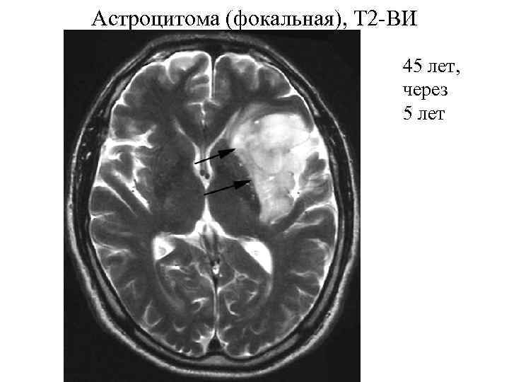 Астроцитома (фокальная), Т 2 -ВИ 45 лет, через 5 лет 