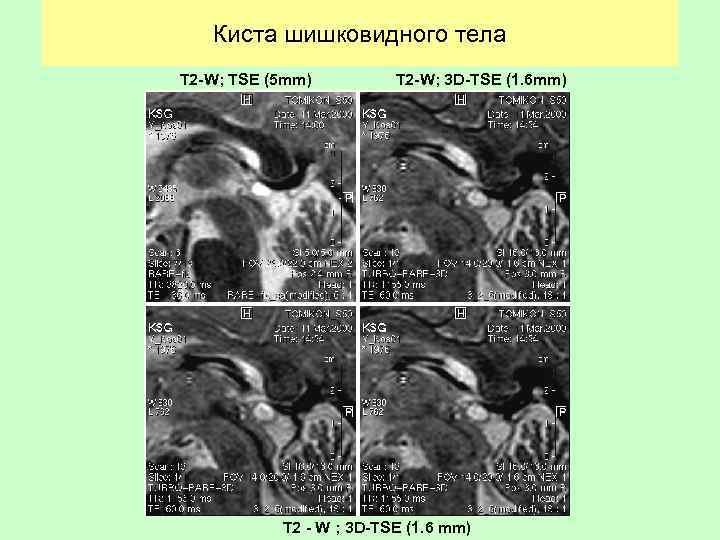 Киста шишковидного тела T 2 -W; TSE (5 mm) T 2 -W; 3 D-TSE