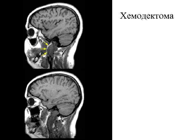 Хемодектома 