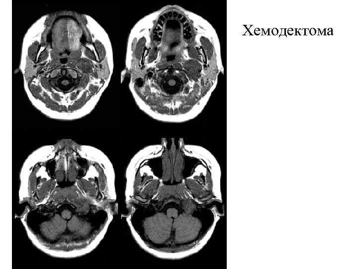 Хемодектома 