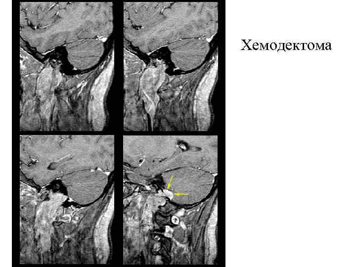 Хемодектома 