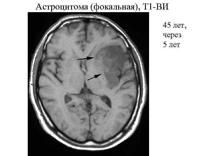 Астроцитома головного мозга прогноз жизни после операции. Астроцитома затылочной доли диффузная. Кт признаки астроцитомы. Астроцитома что это за болезнь.