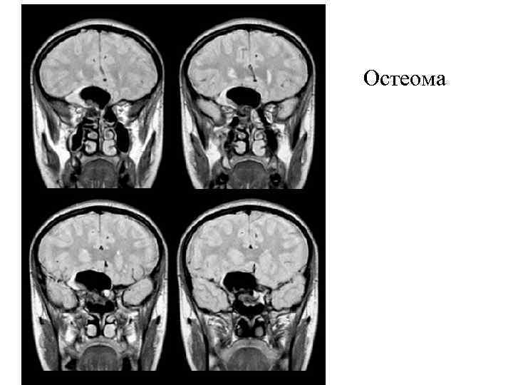 Остеома 
