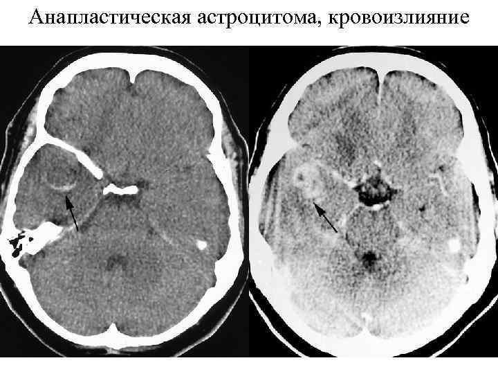 Анапластическая астроцитома, кровоизлияние 