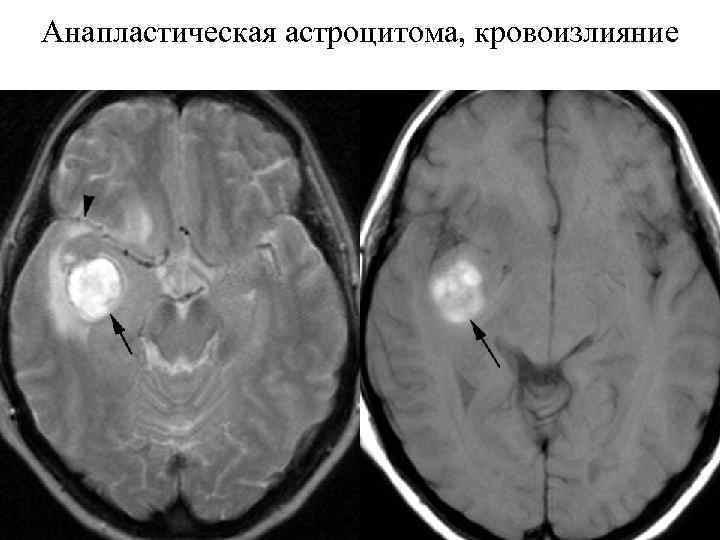 Диффузная астроцитома. Анапластическая астроцитома. Глиальная астроцитома. Фибриллярная астроцитома.