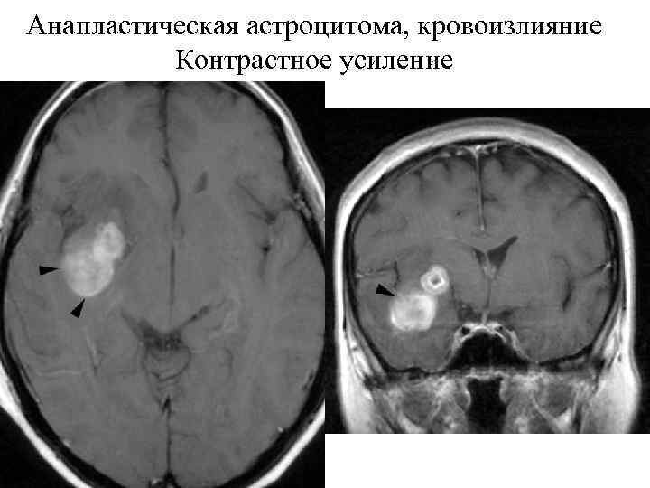 Астроцитома головного мозга прогноз. Анапластическая астроцитома. Глиальная астроцитома. Мультифокальная анапластическая астроцитома. Астроцитома головного мозга кт.