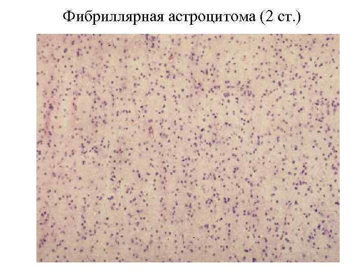 Фибриллярная астроцитома (2 ст. ) 