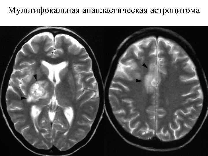 Мультифокальная анапластическая астроцитома 