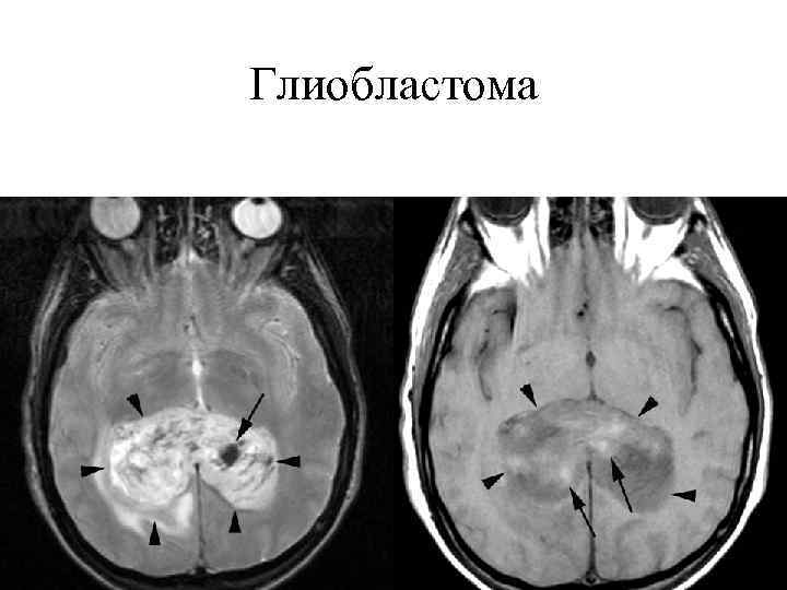 Глиобластома головного фото