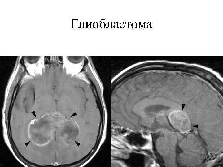 Глиобластома 4g что такое
