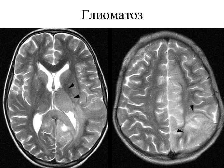 Глиоматоз 