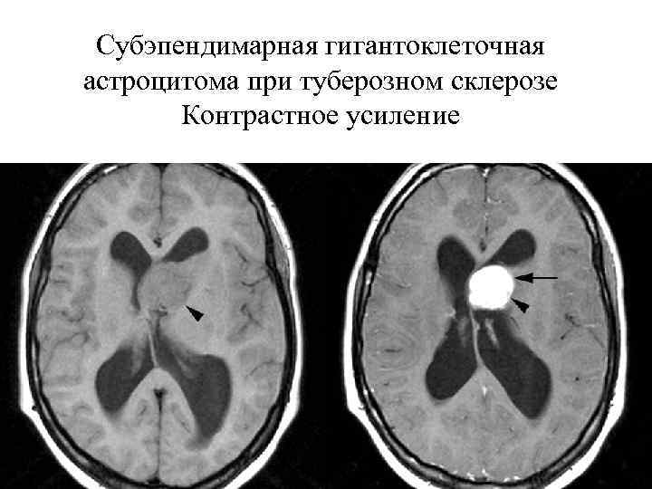 Субэпендимарная гигантоклеточная астроцитома при туберозном склерозе Контрастное усиление 