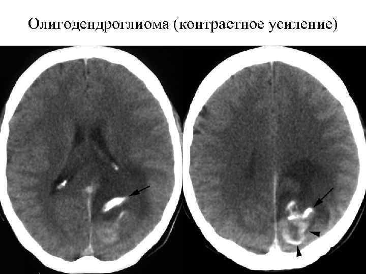Олигодендроглиома (контрастное усиление) 
