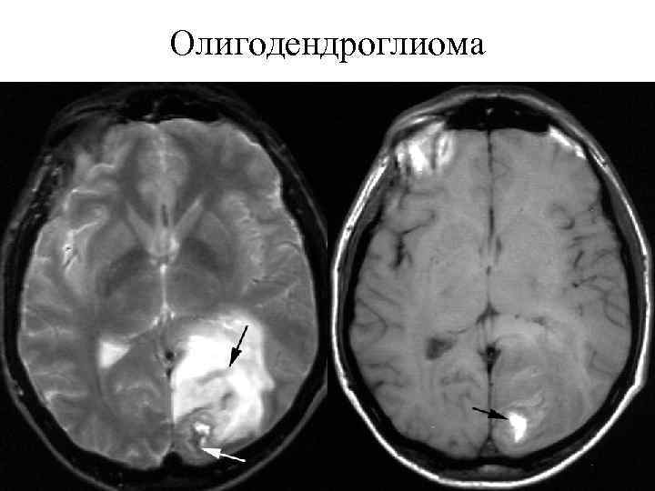 Астроцитома головного мозга прогноз. Анапластическая астроцитома. Олигодендроглиома спектроскопия. Олигодендроглиома головного мозга мрт. Олигодендроглиома гистология.