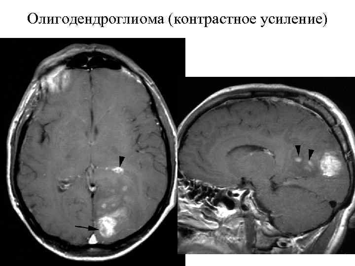 Олигодендроглиома (контрастное усиление) 