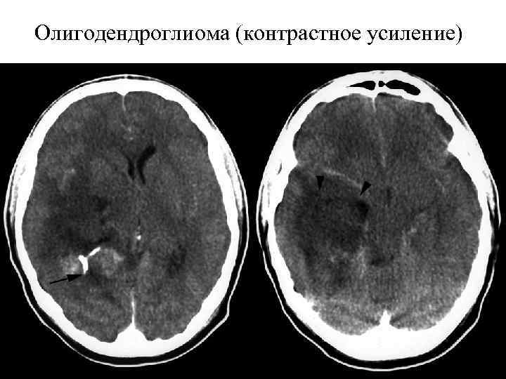 Олигодендроглиома (контрастное усиление) 