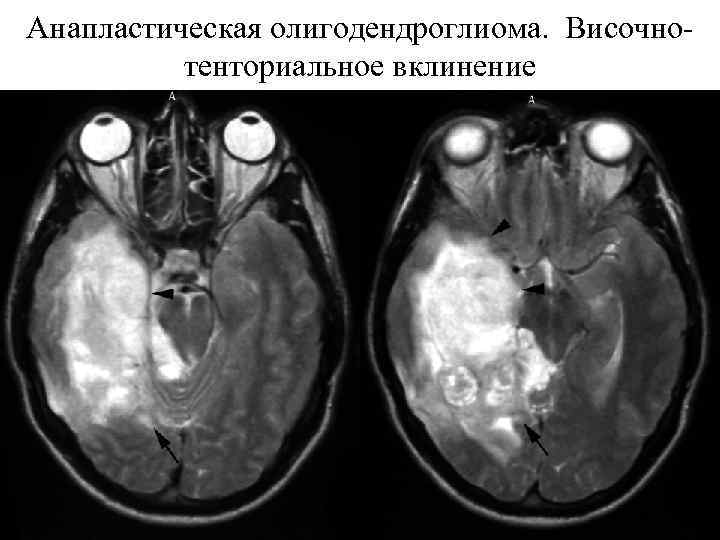 Глиальная опухоль головного. Анапластическая олигодендроглиома. Олигодендроглиома головного мозга кт. Анапластическая олигодендроглиома мрт. Олигодендроглиома гистология.