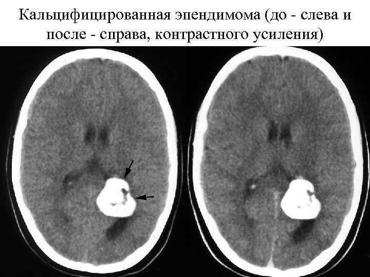 Кальцифицированная эпендимома (до - слева и после - справа, контрастного усиления) 
