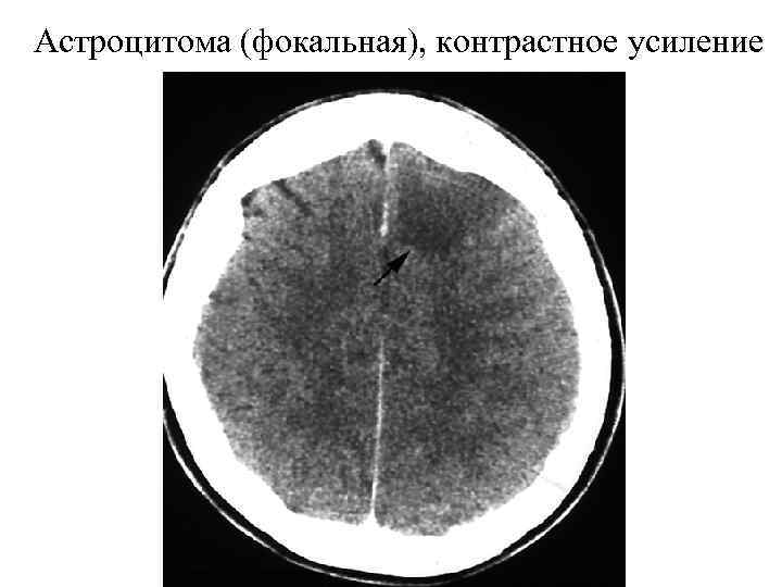 Астроцитома (фокальная), контрастное усиление 