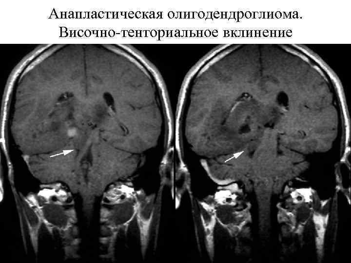 Анапластическая олигодендроглиома. Височно-тенториальное вклинение 