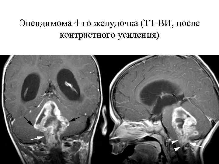 Эпендимома 4 -го желудочка (Т 1 -ВИ, после контрастного усиления) 