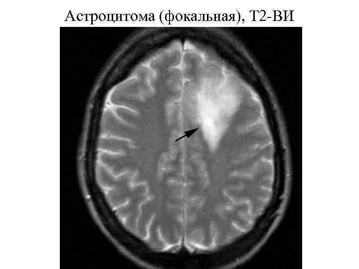 Астроцитома головного мозга прогноз жизни после операции