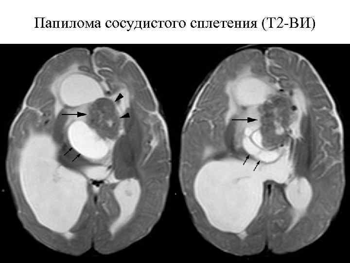Папилома сосудистого сплетения (Т 2 -ВИ) 