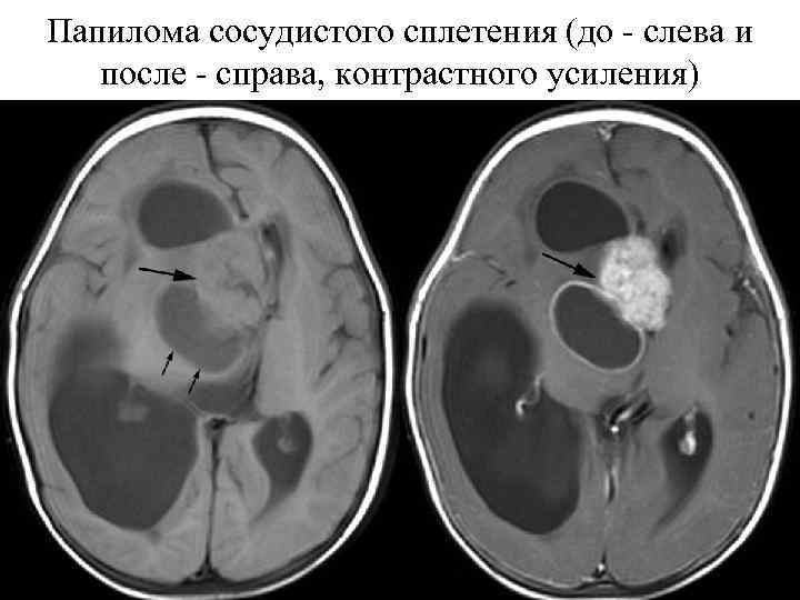 Папилома сосудистого сплетения (до - слева и после - справа, контрастного усиления) 