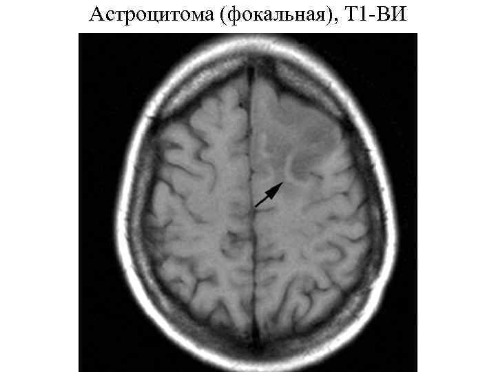 Астроцитома (фокальная), Т 1 -ВИ 