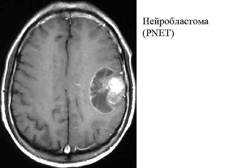 Нейробластома головного